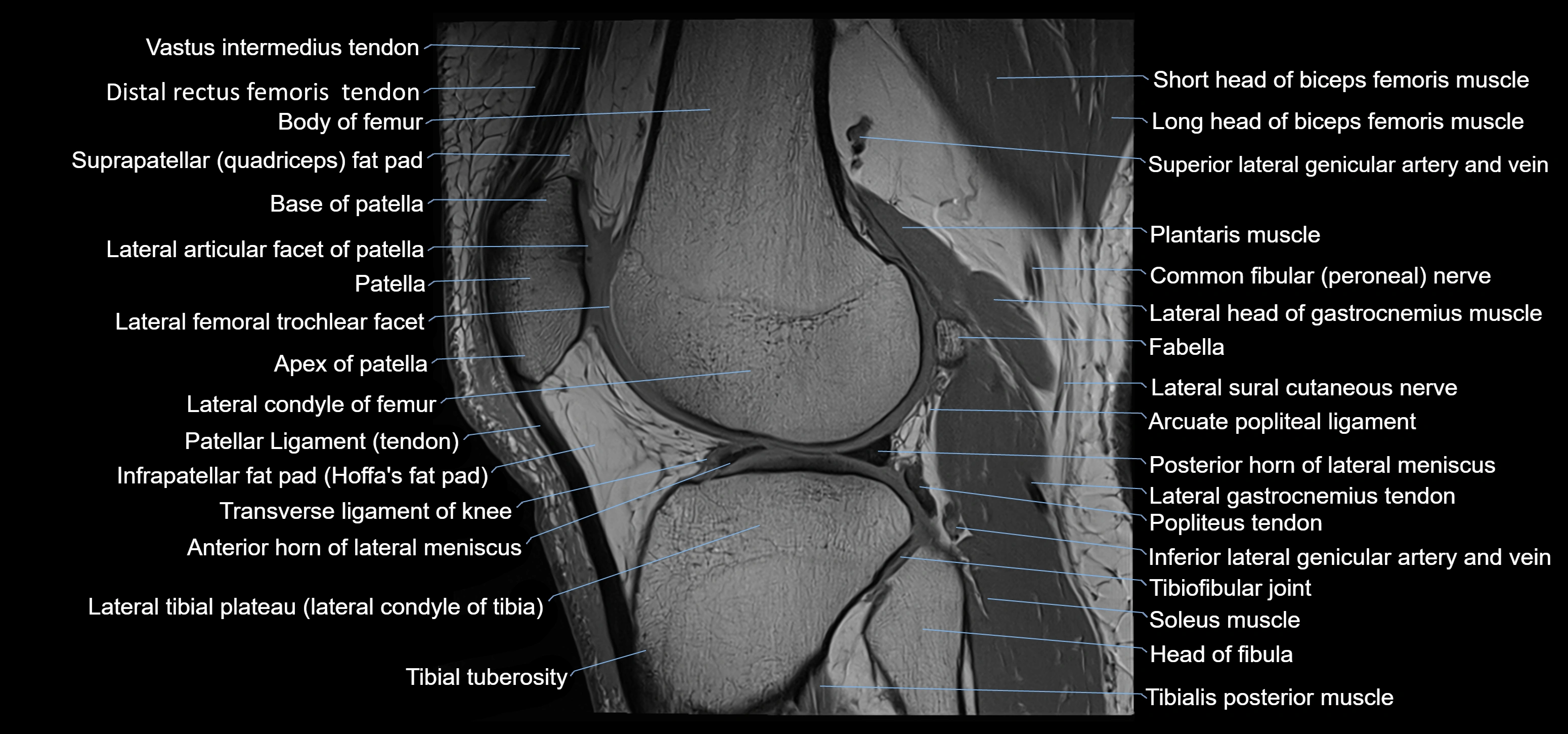 MRI knee sagittal cross sectional anatomy labelled 3T radiology image-00033.webp